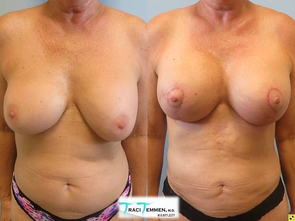 Breast Augmentation With Lift Before & After