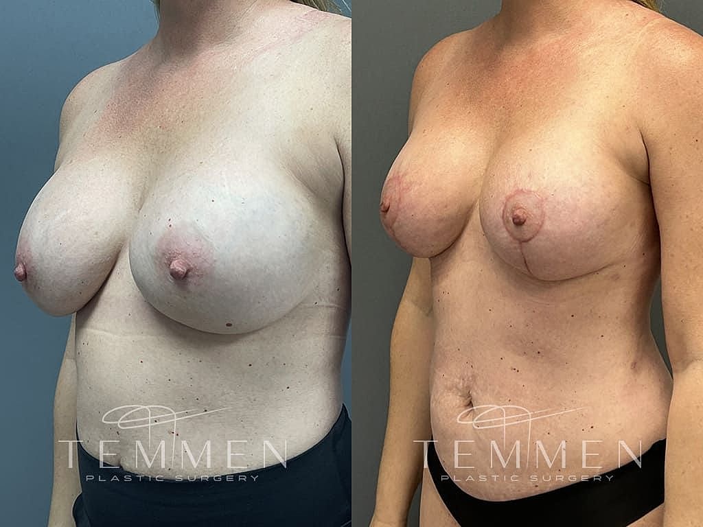 Breast Augmentation With Lift Before & After