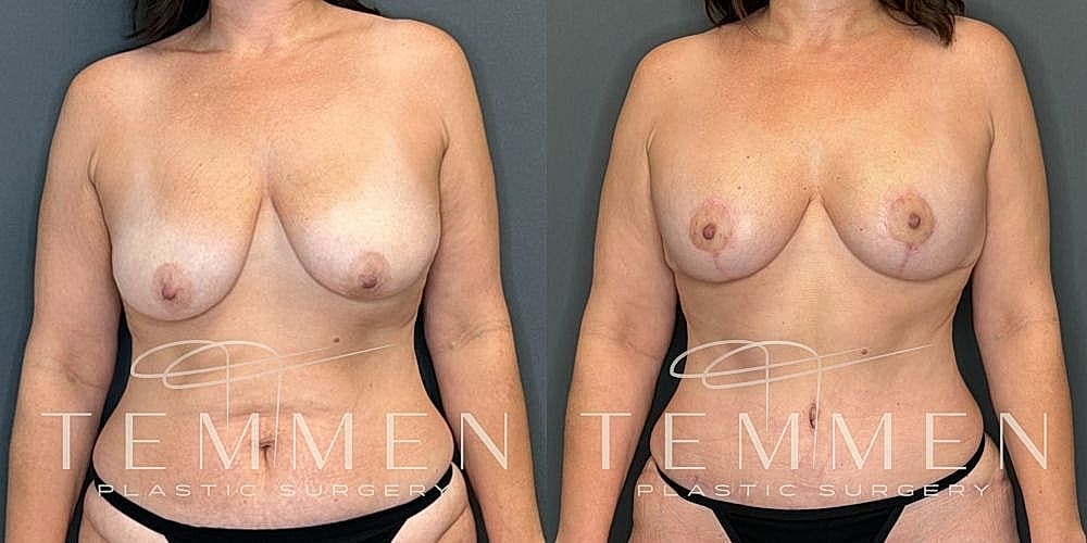 Before and after breast augmentation photos.