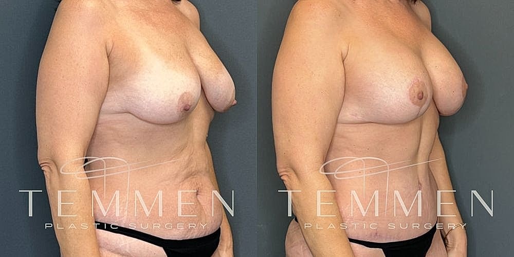 Before and after plastic surgery side profile comparison.