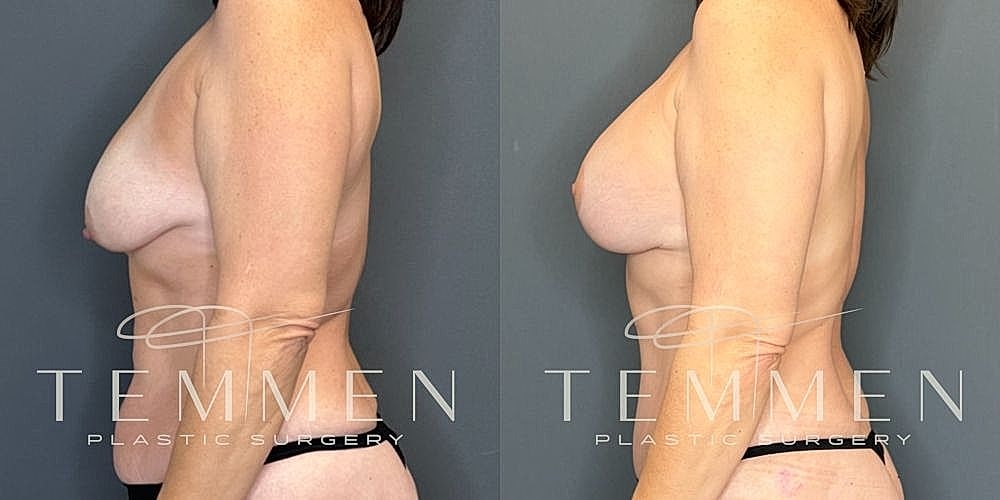 Before and after plastic surgery side profile.