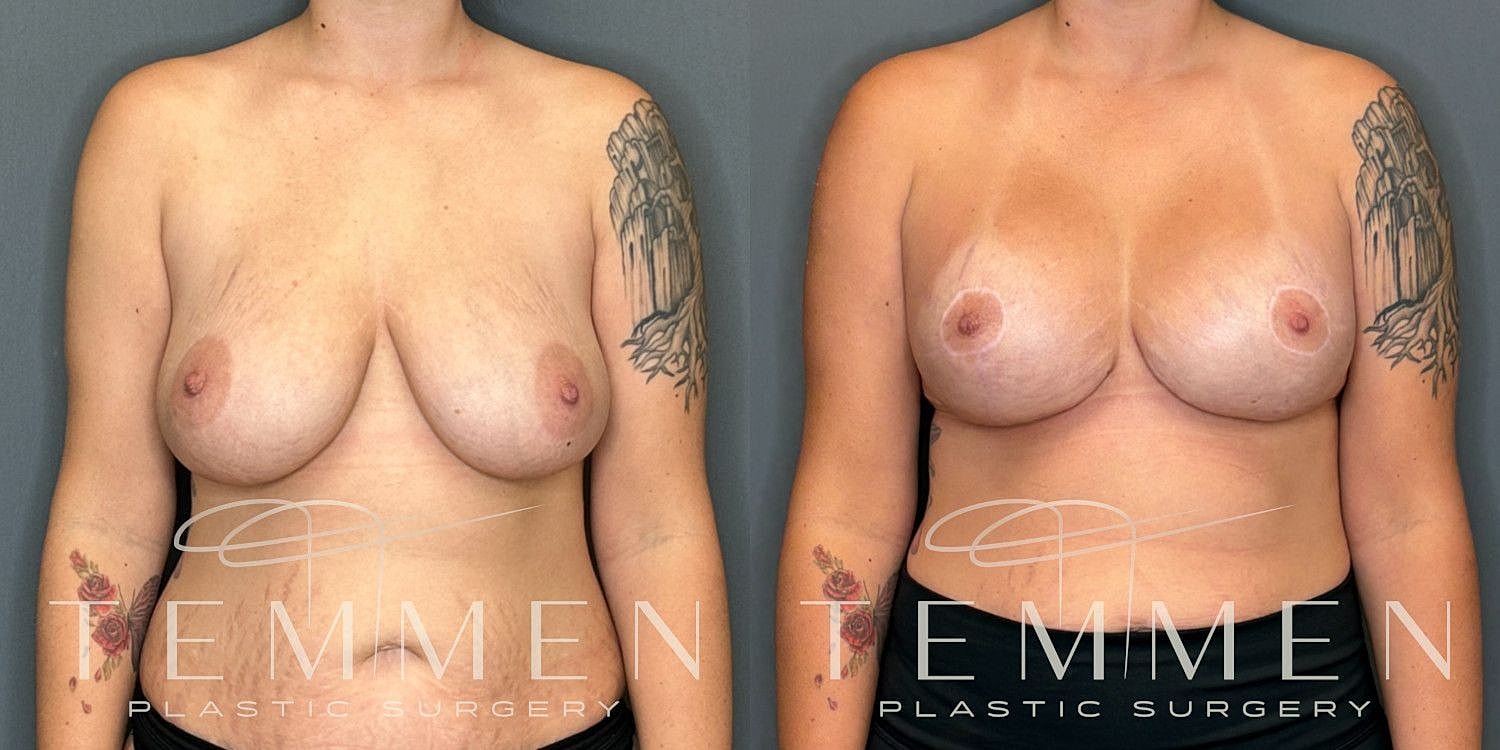 Breast Augmentation With Lift Before & After