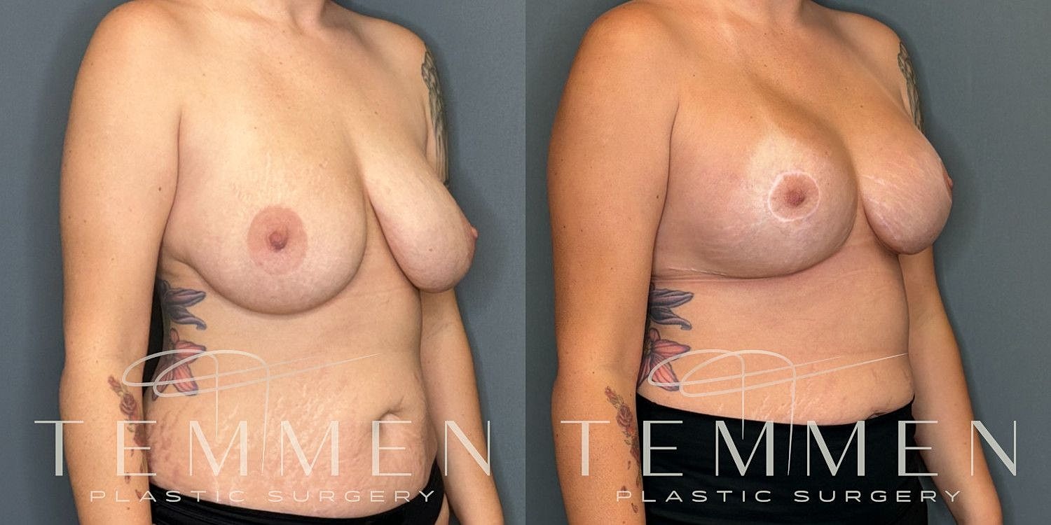 Breast Augmentation With Lift Before & After
