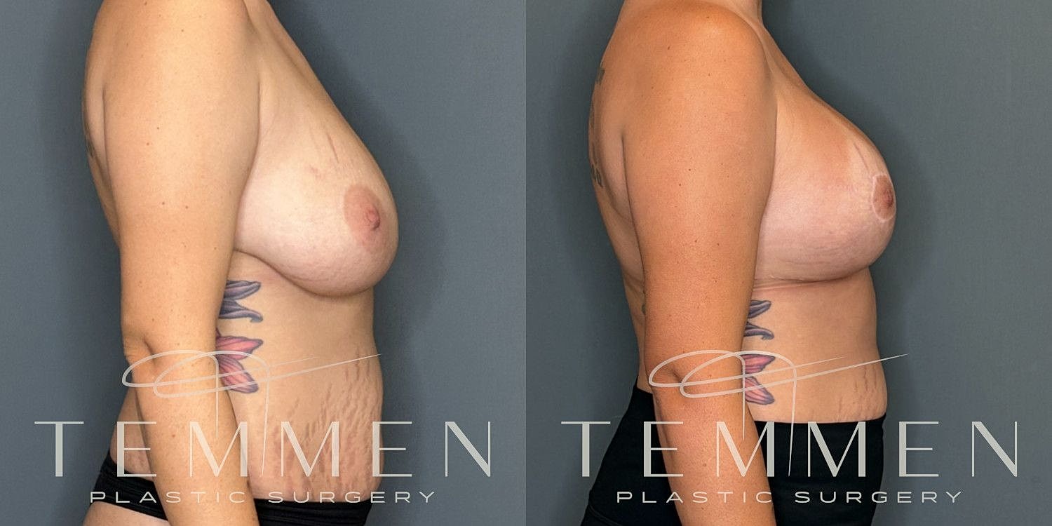 Breast Augmentation With Lift Before & After