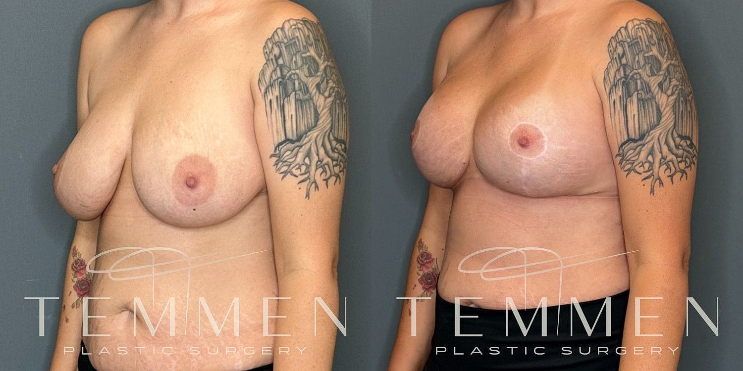 Breast Augmentation With Lift Before & After