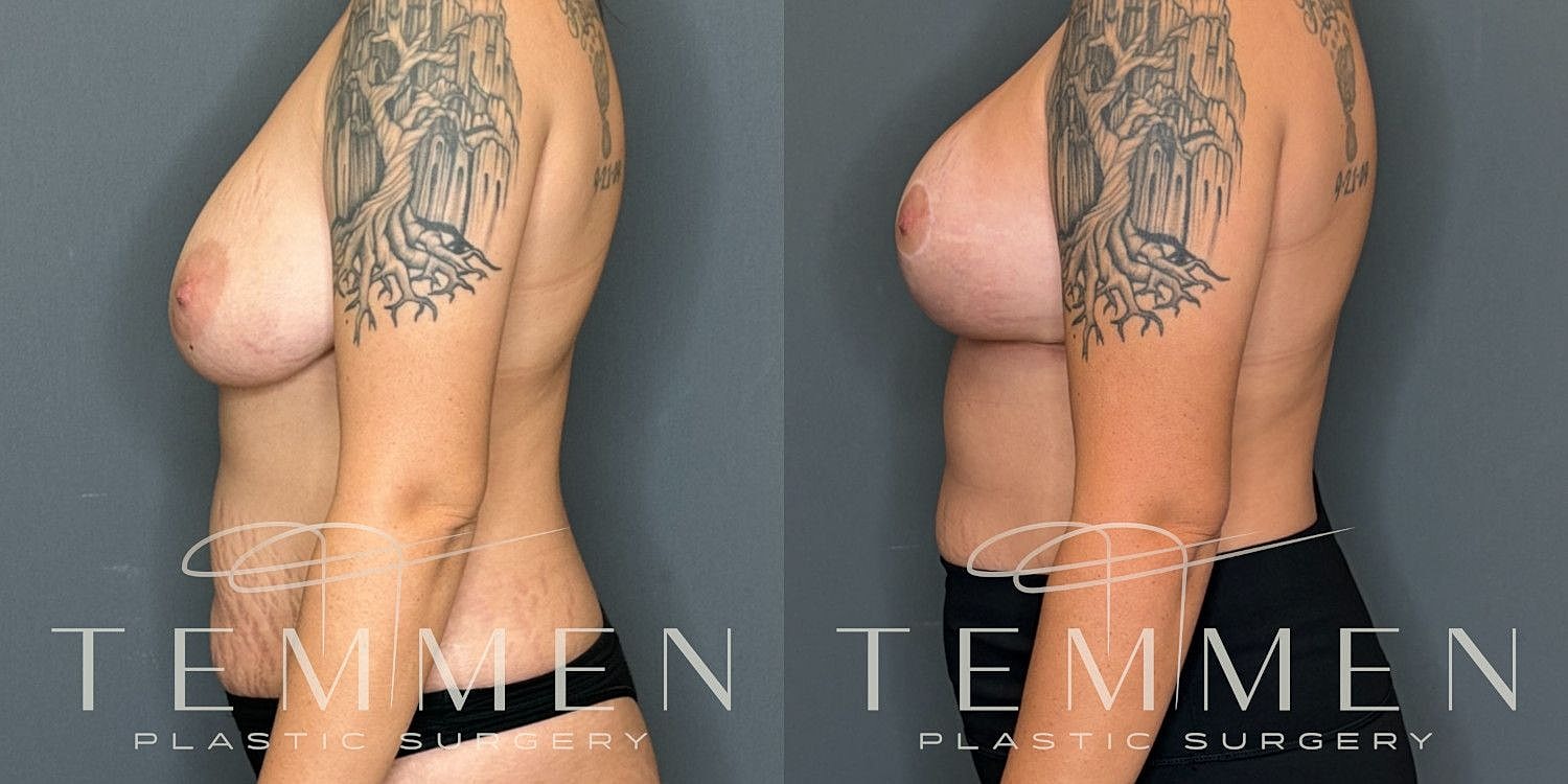 Breast Augmentation With Lift Before & After