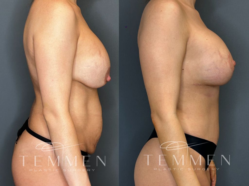 Breast Augmentation With Lift Before & After