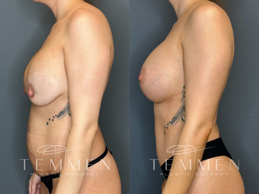 Breast Augmentation With Lift Before & After