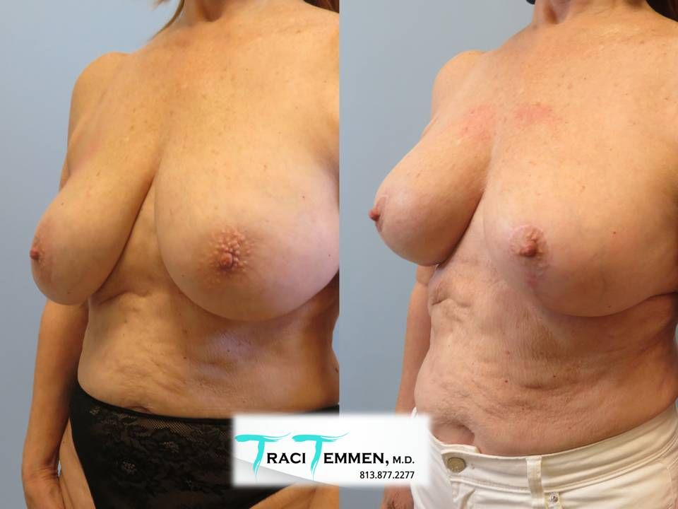 Breast Augmentation With Lift Before & After