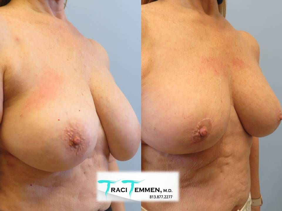 Breast Augmentation With Lift Before & After