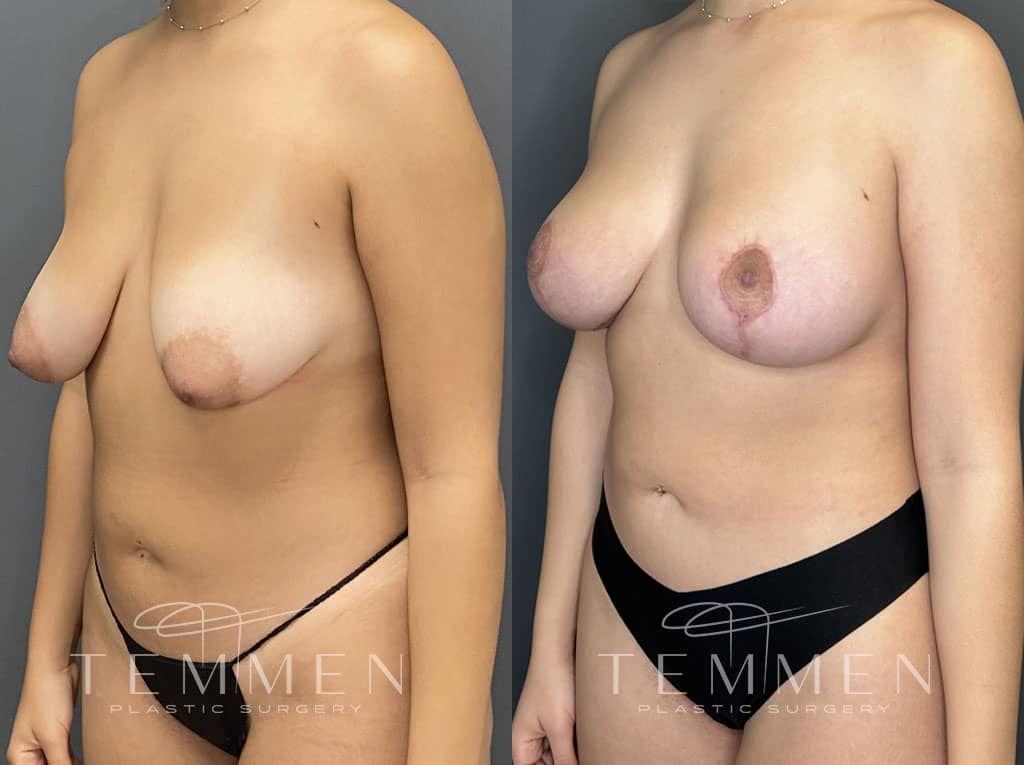 Breast Augmentation With Lift Before & After
