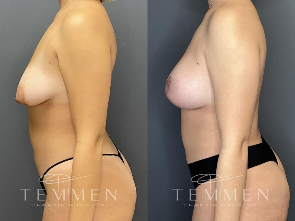 Breast Augmentation With Lift Before & After