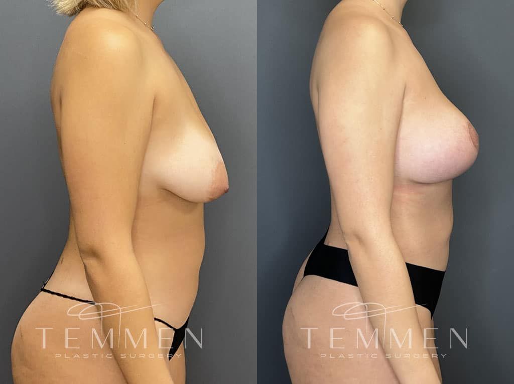 Breast Augmentation With Lift Before & After