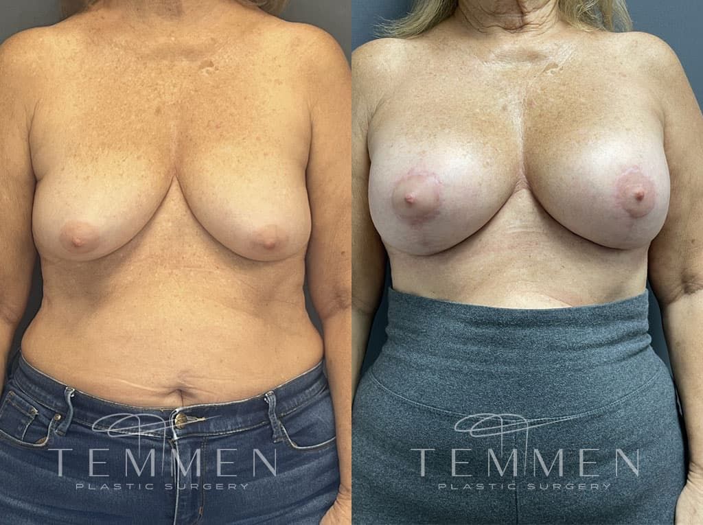 Breast Augmentation With Lift Before & After