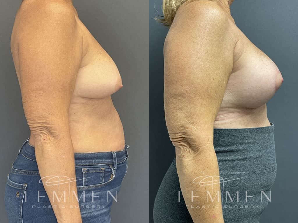 Breast Augmentation With Lift Before & After
