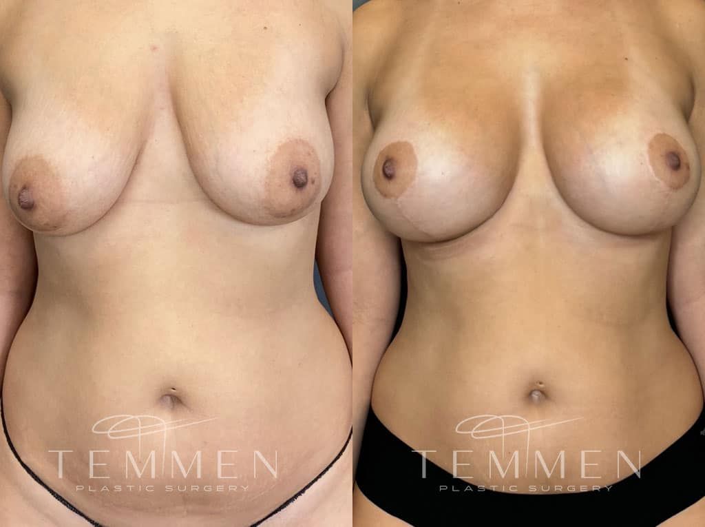 Breast Augmentation With Lift Before & After