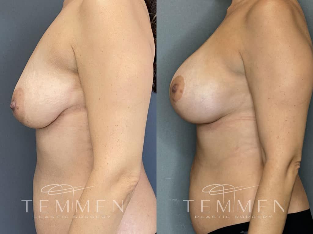 Breast Augmentation With Lift Before & After
