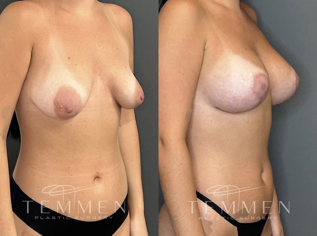 Breast Augmentation With Lift Before & After