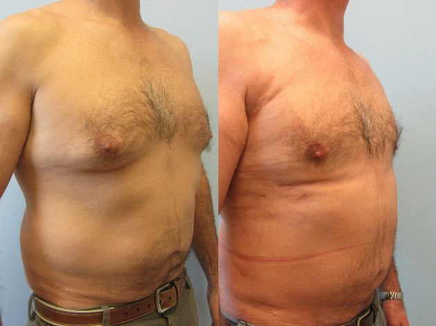 Gynecomastia Before & After