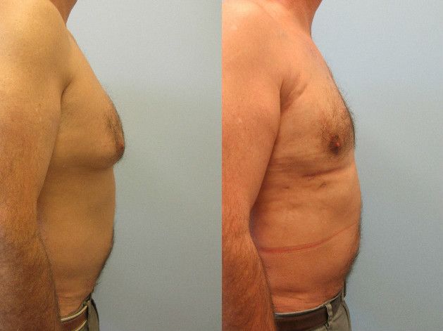 Gynecomastia Before & After