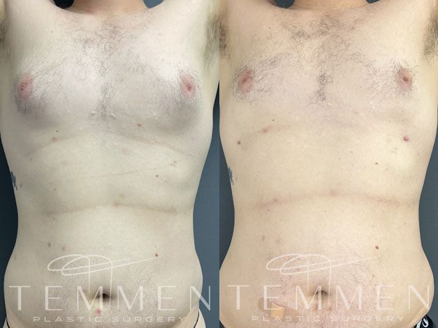 Gynecomastia Before & After