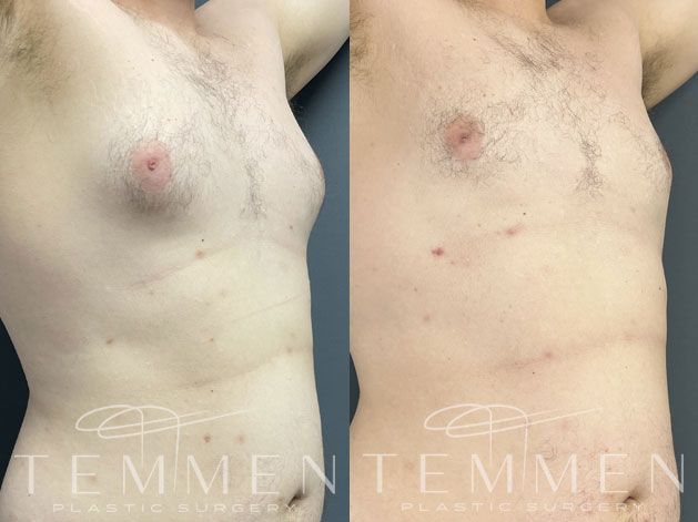 Gynecomastia Before & After