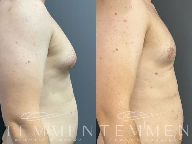 Gynecomastia Before & After