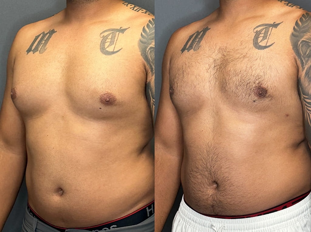 Gynecomastia Before & After