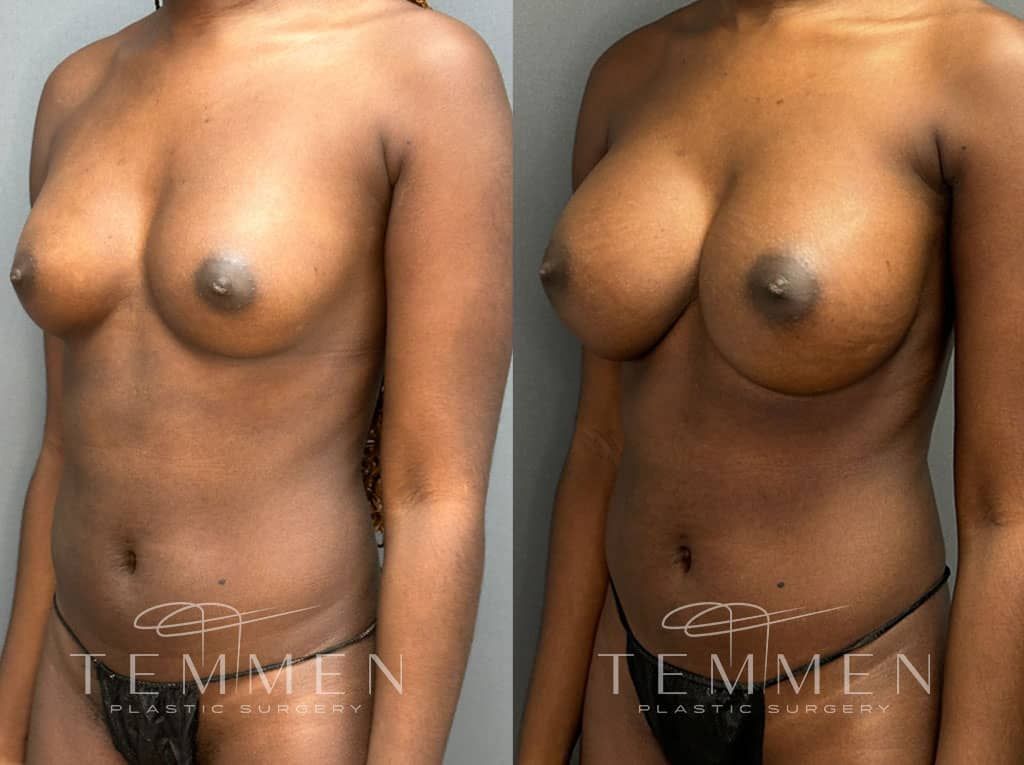 Breast Augmentation Before & After