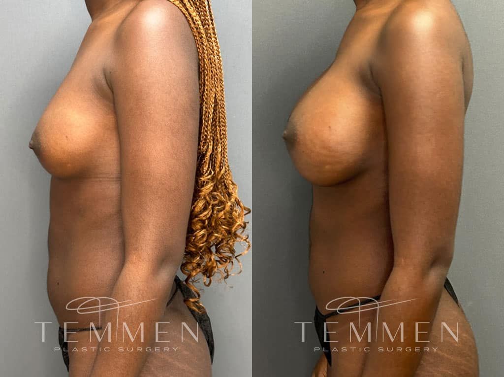 Breast Augmentation Before & After