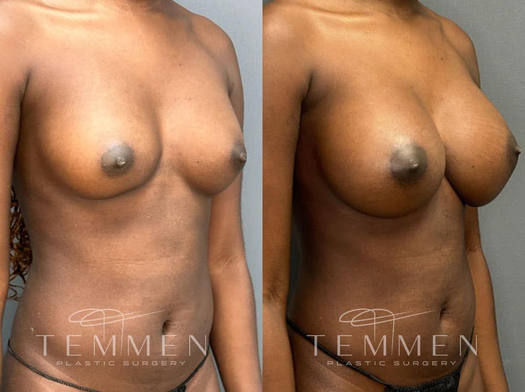 Breast Augmentation Before & After