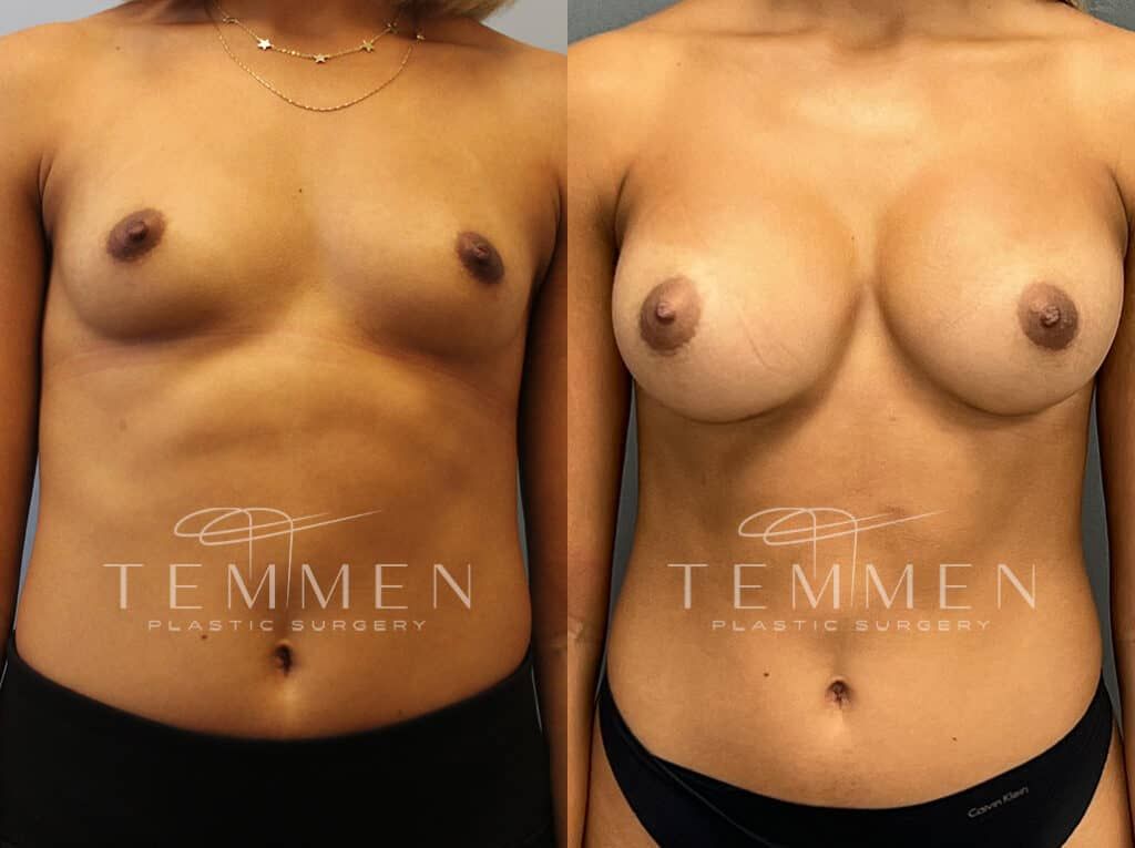 Breast Augmentation Before & After