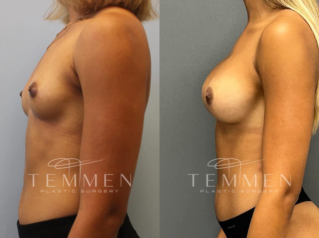 Breast Augmentation Before & After