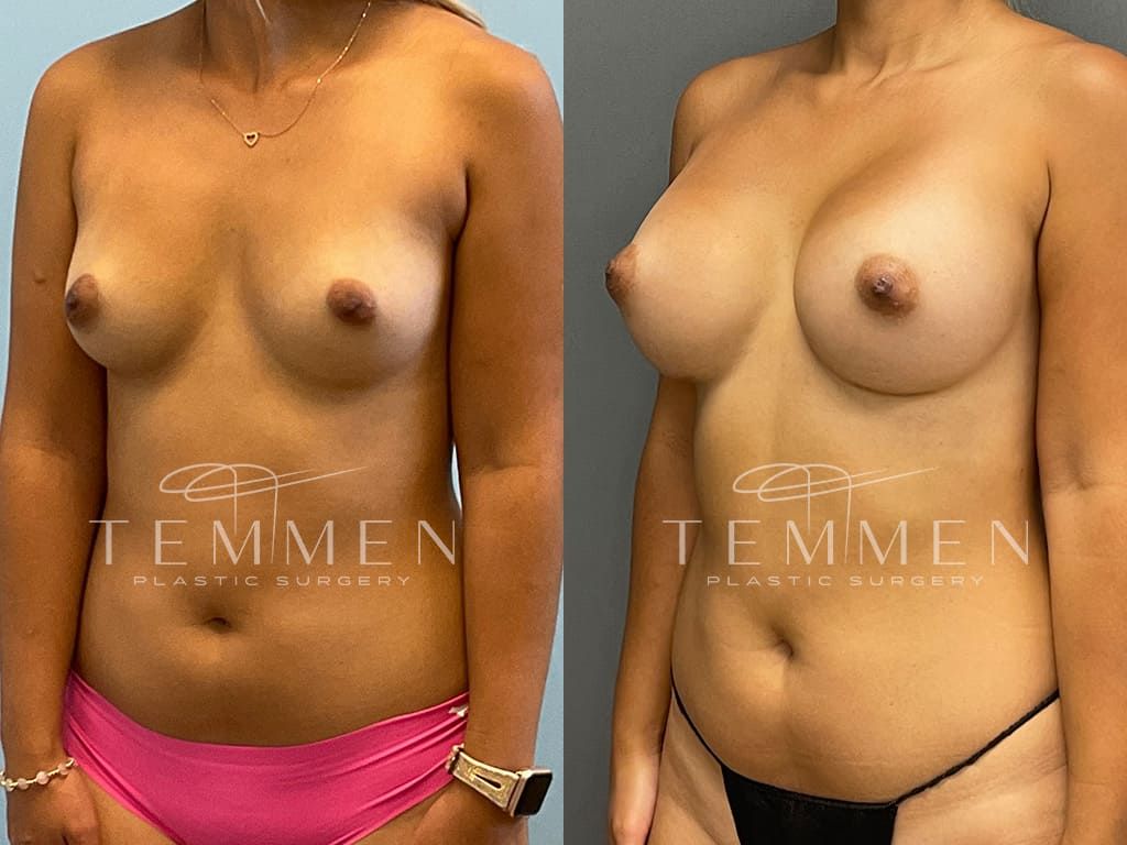 Breast Augmentation Before & After