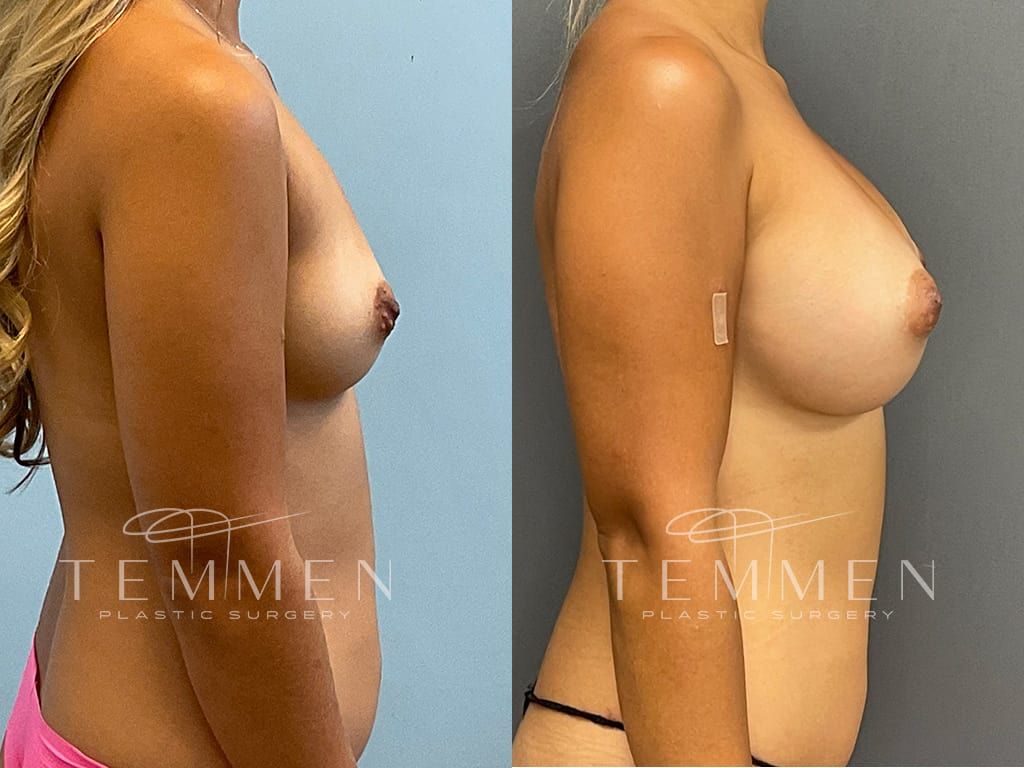 Breast Augmentation Before & After