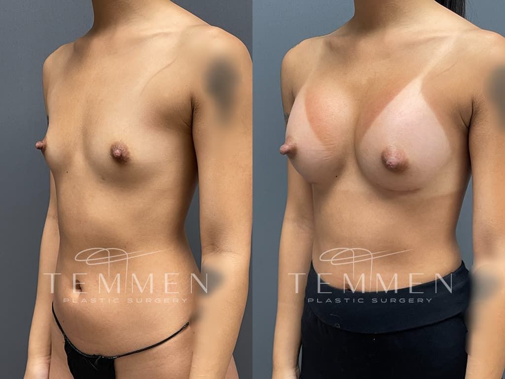 Breast Augmentation Before & After