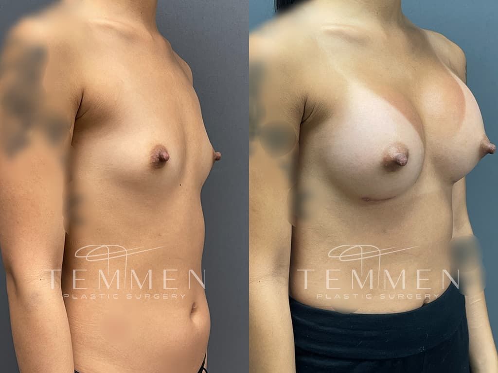 Breast Augmentation Before & After