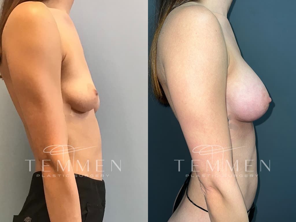 Breast Augmentation Before & After