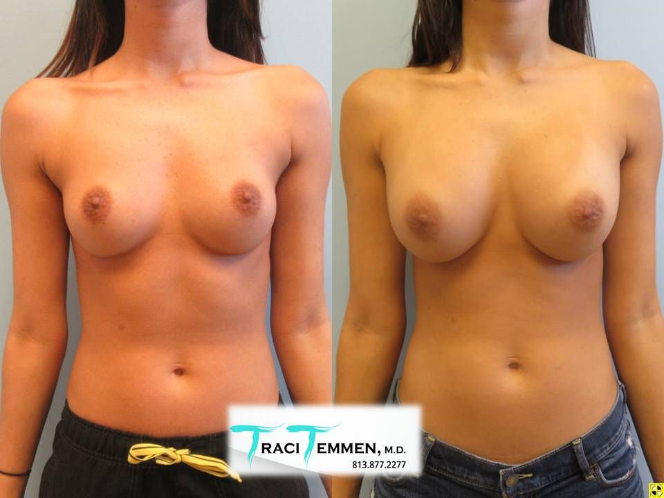 Breast Augmentation Before & After