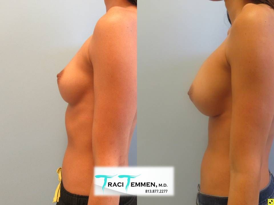 Breast Augmentation Before & After