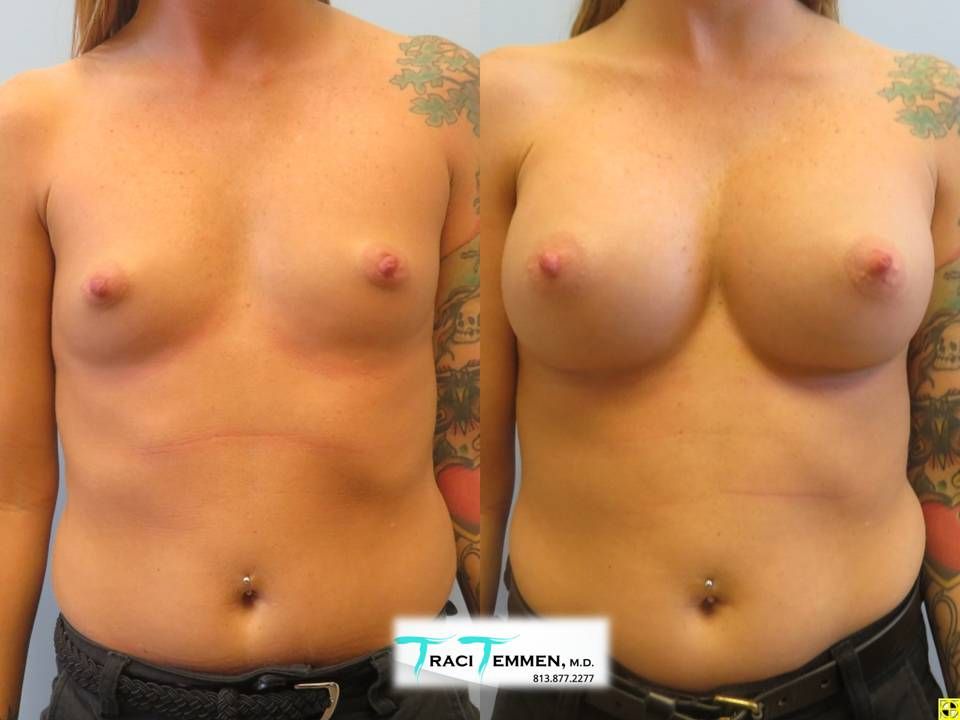 Breast Augmentation Before & After