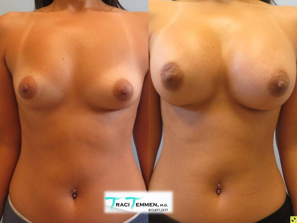 Breast Augmentation Before & After
