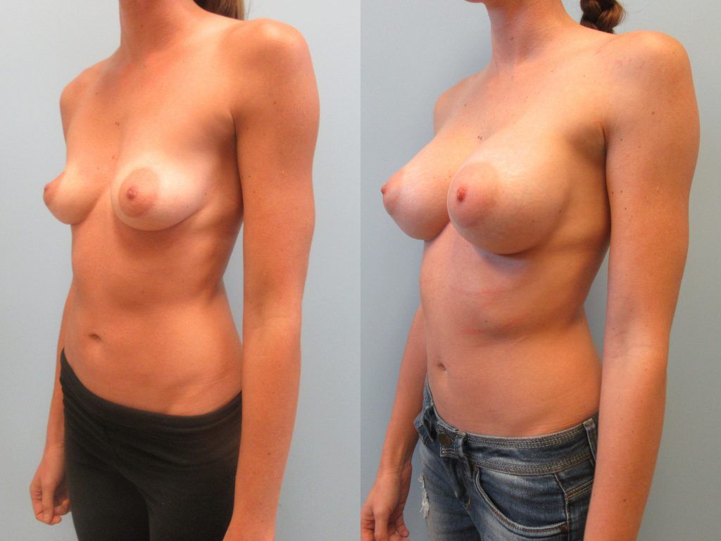 Breast Augmentation Before & After