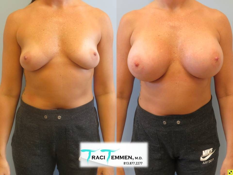 Breast Augmentation Before & After