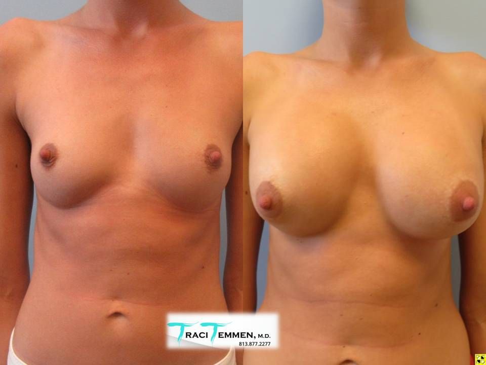 Breast Augmentation Before & After