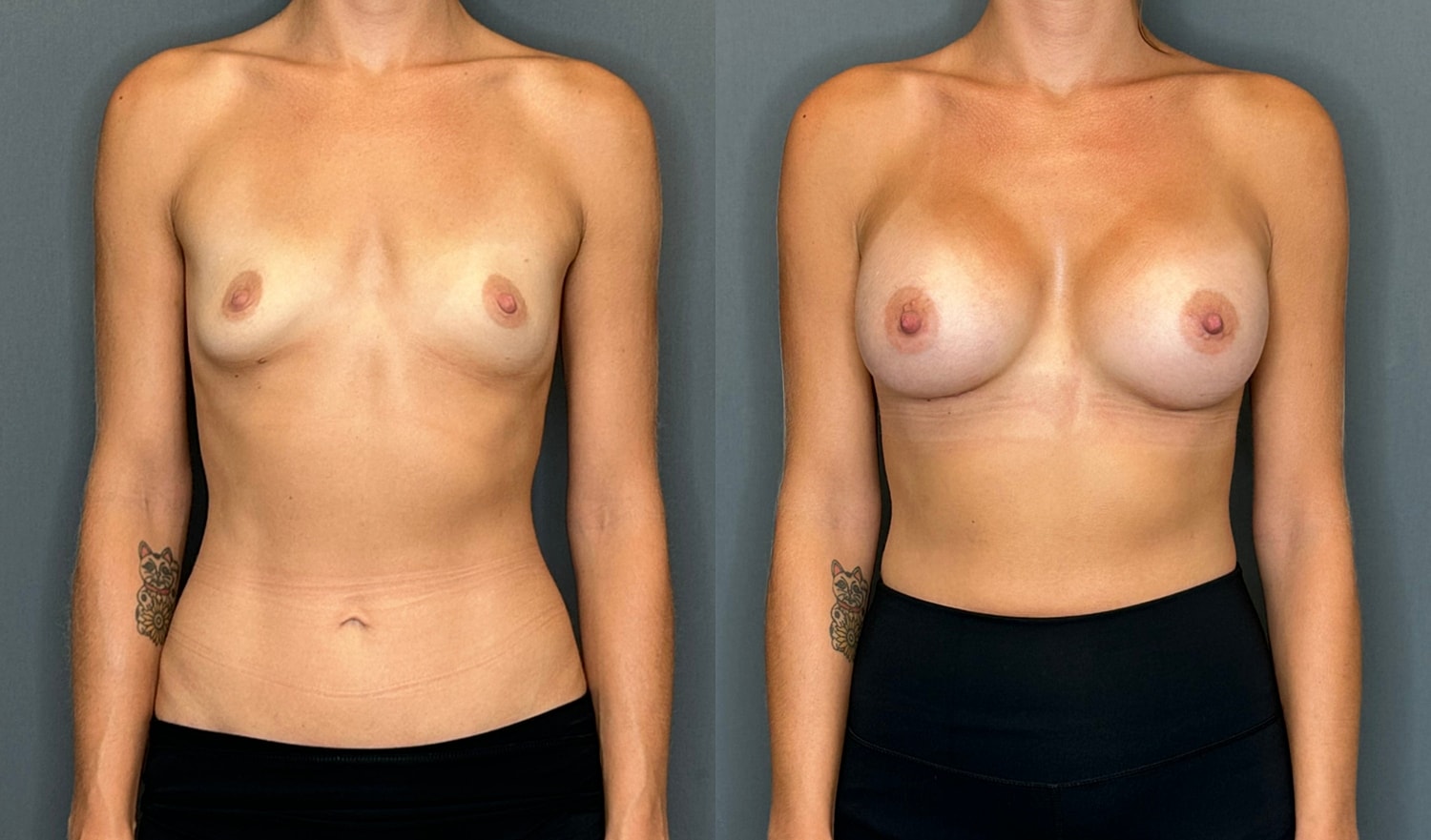 Breast Augmentation Before & After