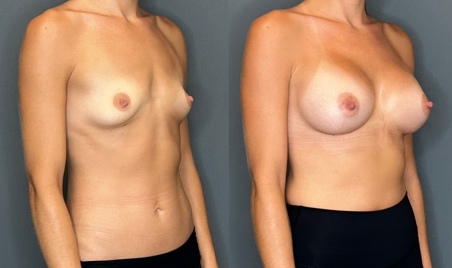Breast Augmentation Before & After