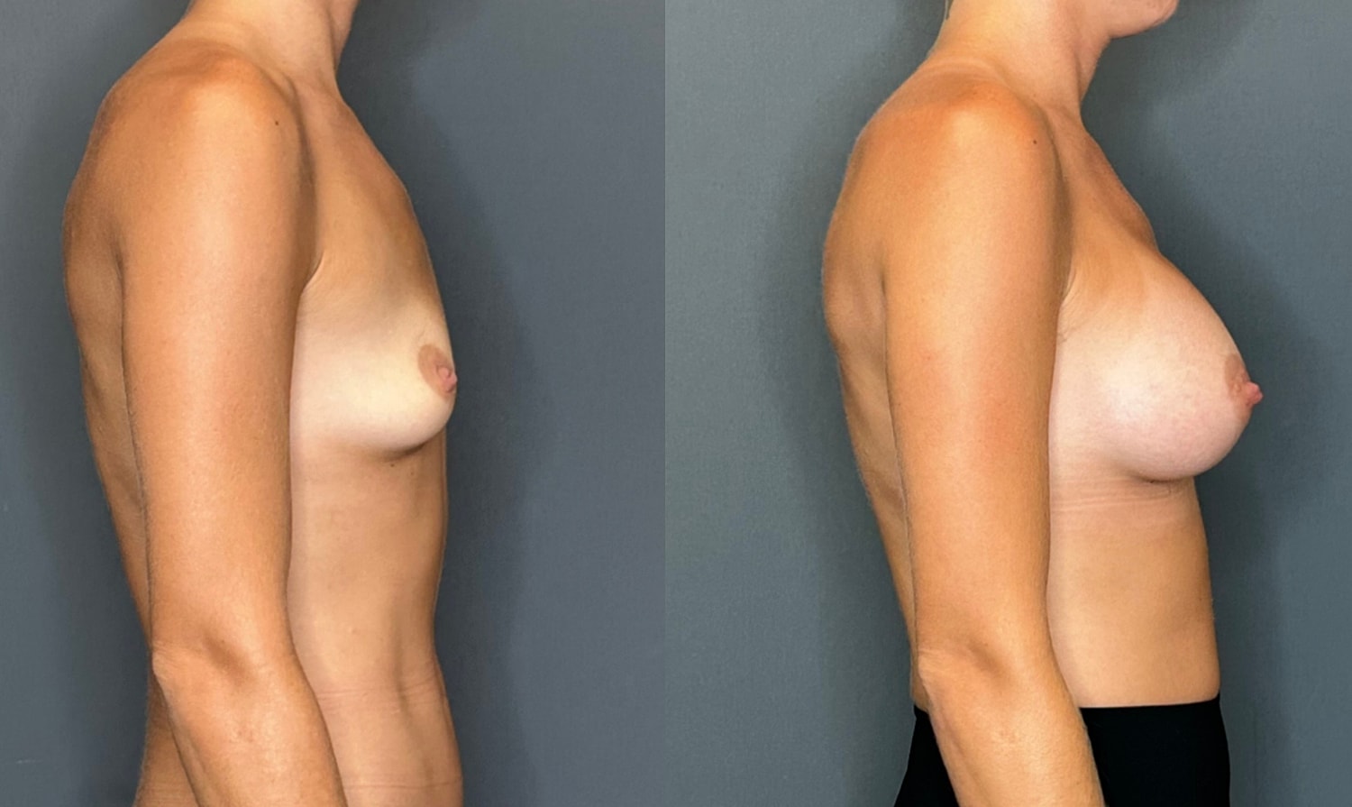 Breast Augmentation Before & After