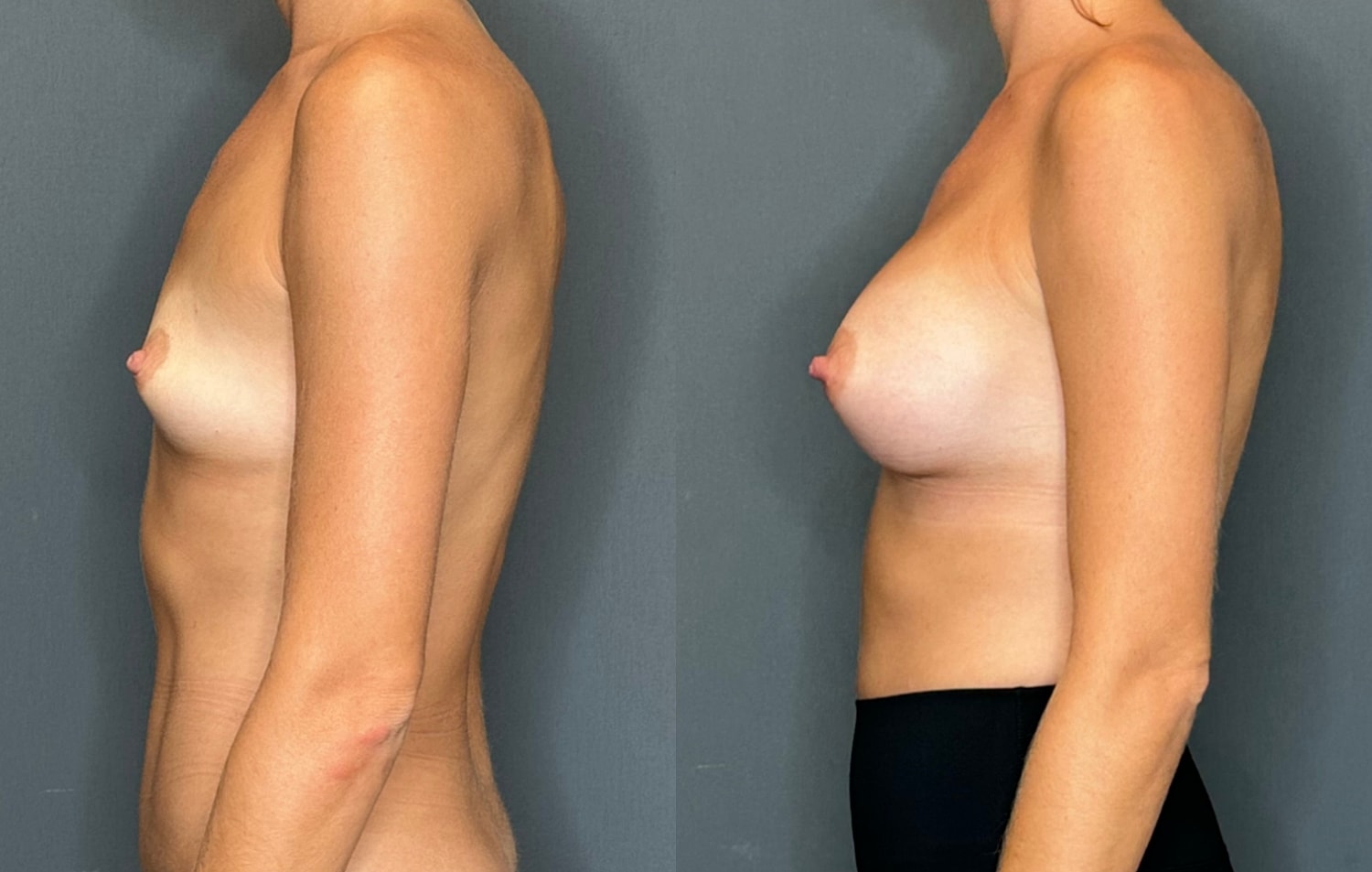 Breast Augmentation Before & After
