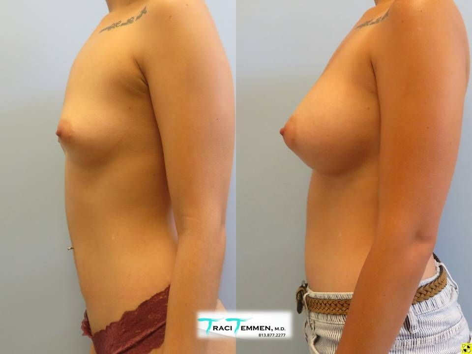Breast Augmentation Before & After